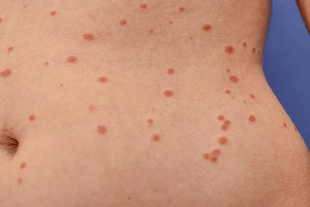 Psoriasis Guttata: Causas, Síntomas Y Tratamiento